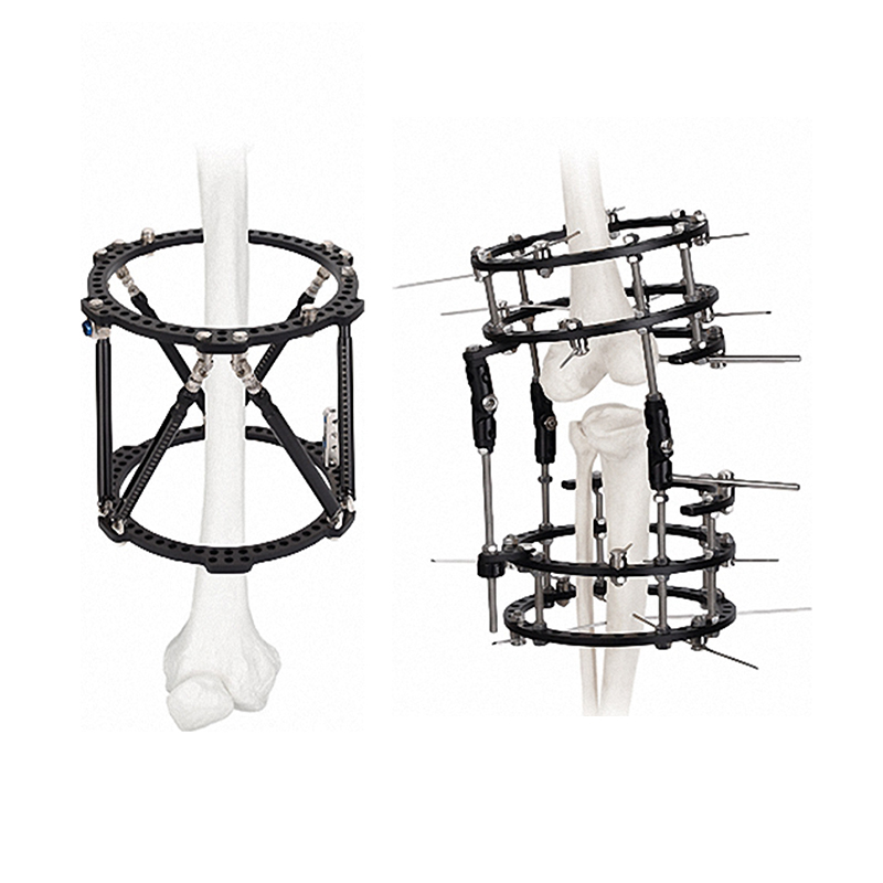 Bone External Fixator System
